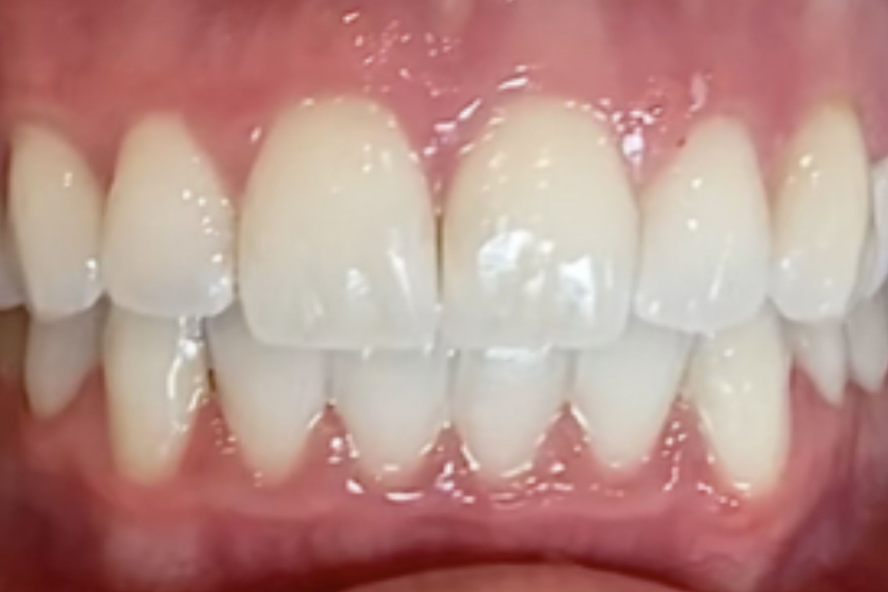 بعد از سفید کردن