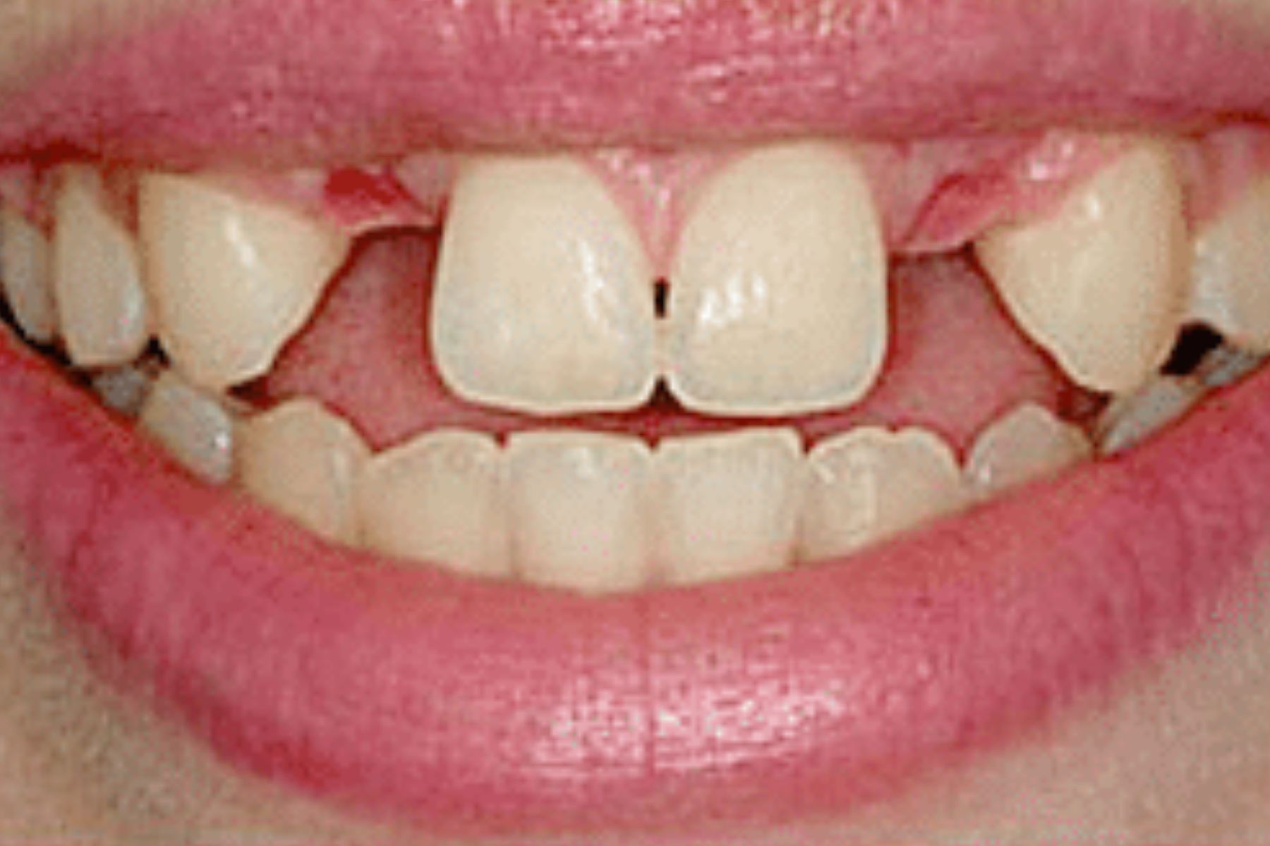 قبل از ایمپلنت