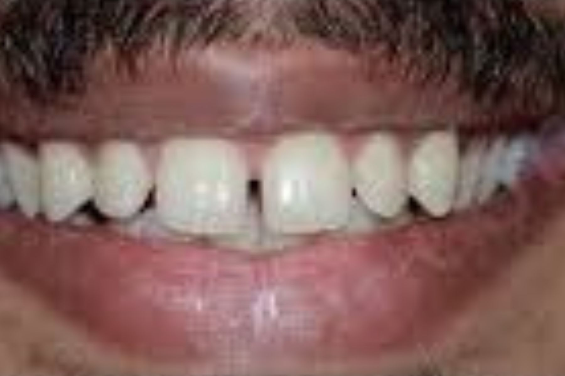 قبل از ارتودنسی