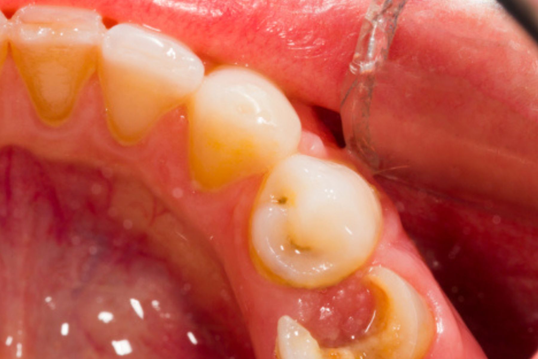 قبل از درمان ریشه 